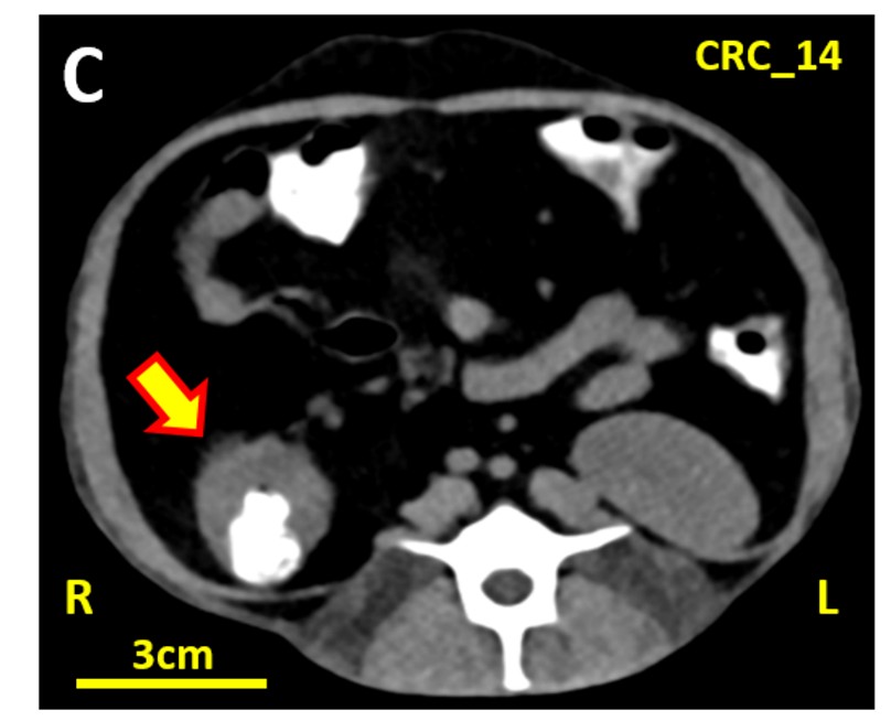 Imaging of spontaneous colorectal cancer in nonhuman primates.